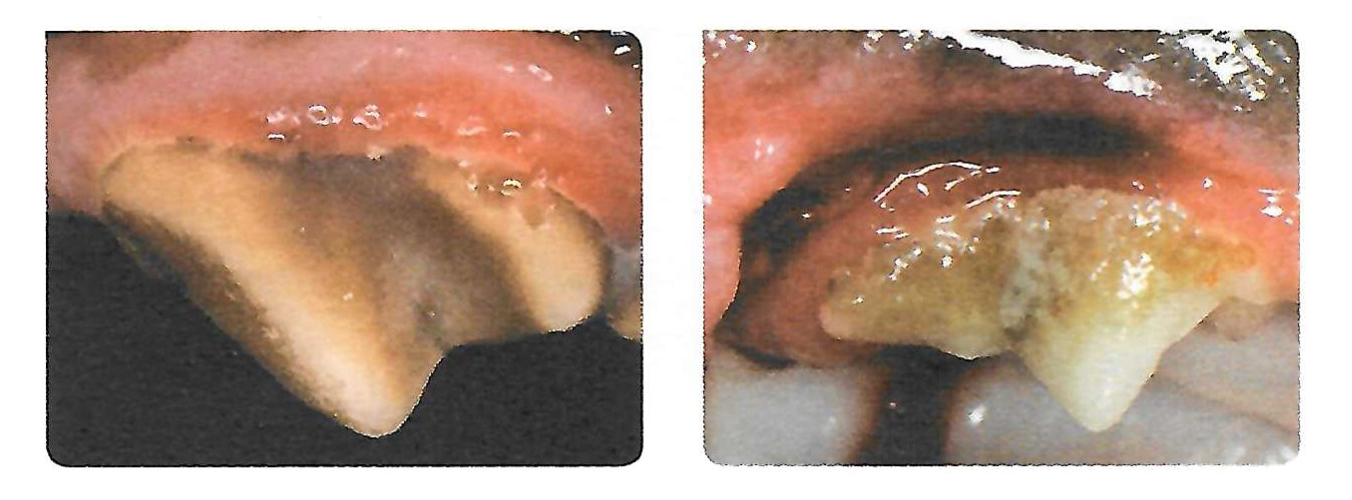 Stage 1: Gingivitis